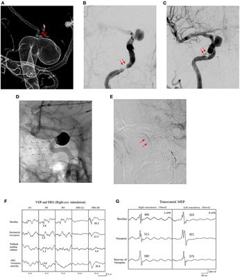 Diagnostic Impact of Monitoring Visual Evoked Potentials to Prevent Visual Complications During Endovascular Treatment for Intracranial Aneurysm